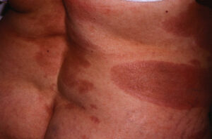 Á vảy nến và vảy phấn dạng lichen