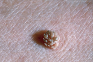 hạt cơm mụn cóc