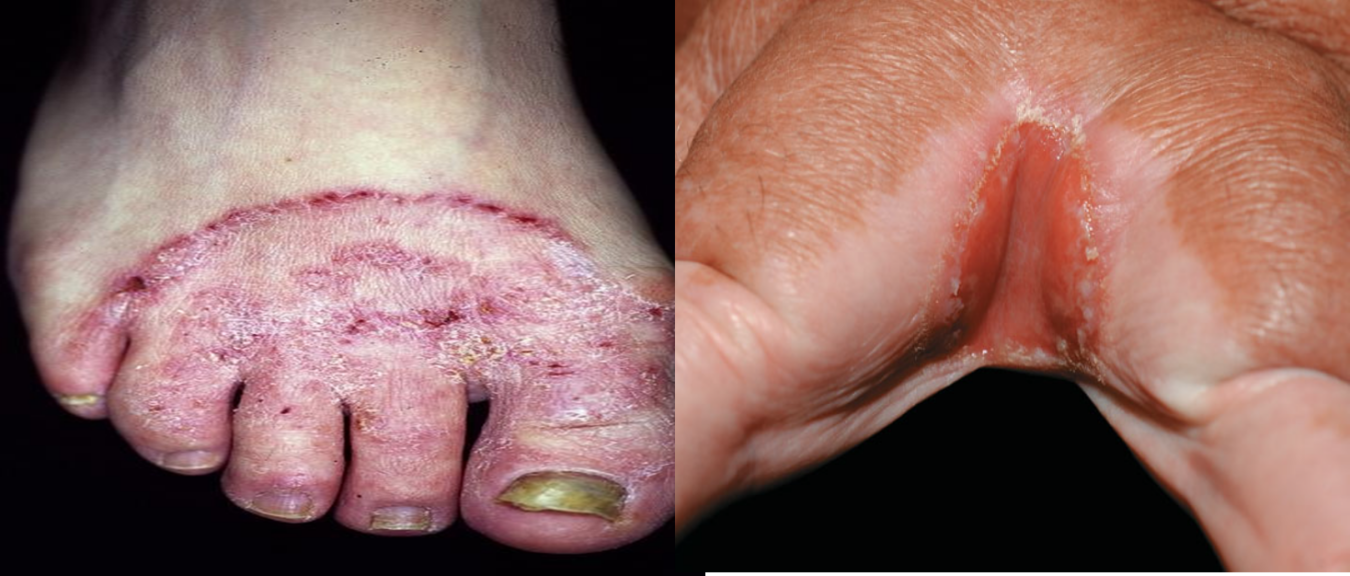 tổn thương của bệnh nấm nông ở bàn chân