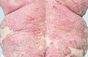 Bệnh vảy nến có tổn thương cơ bản là dát đỏ có vảy