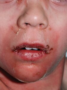 hội chứng bong vảy da do tụ cầu