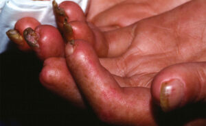 bệnh xơ cứng bì hệ thống