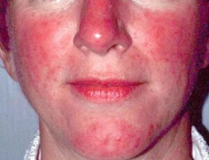 Lupus ban đỏ hệ thống