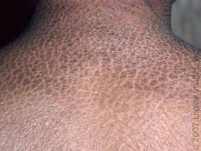 bệnh vảy cá, bệnh da di truyền