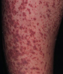 Hội chứng tăng nhạy cảm do thuốc