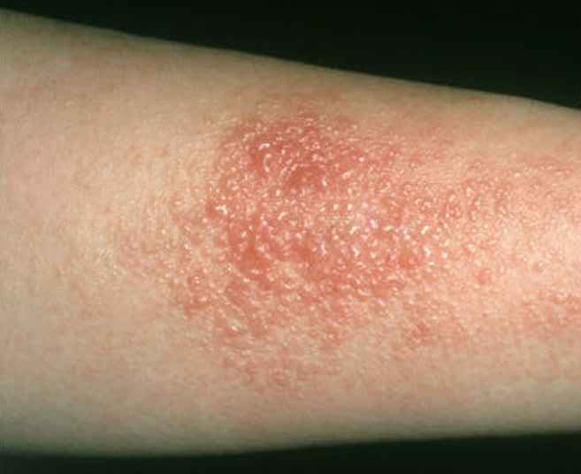 Viêm da tiếp xúc (Contact dermatitis)