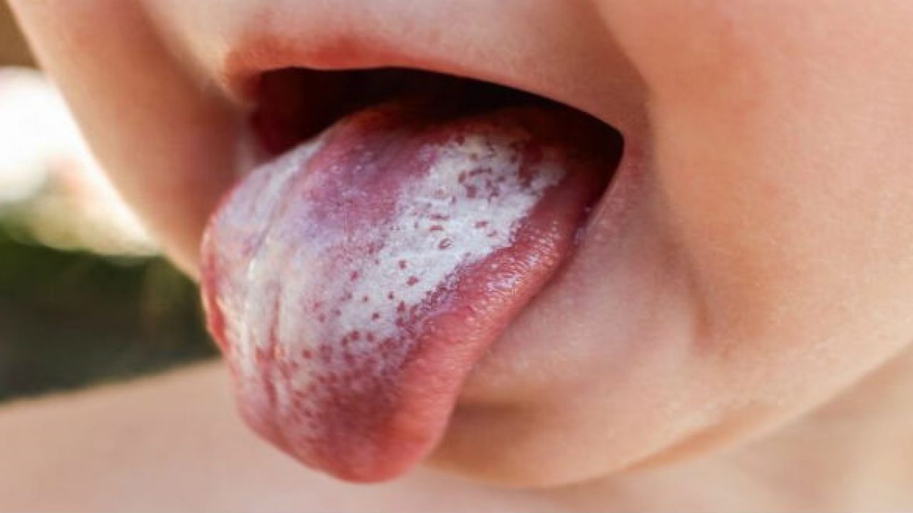 Xuất hiện trên google khi tìm kiếm "Candida" "bệnh da do nấm candida" "tưa miệng" "nấm miệng"