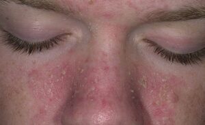 viem-da-dau-o-nguoi-lon