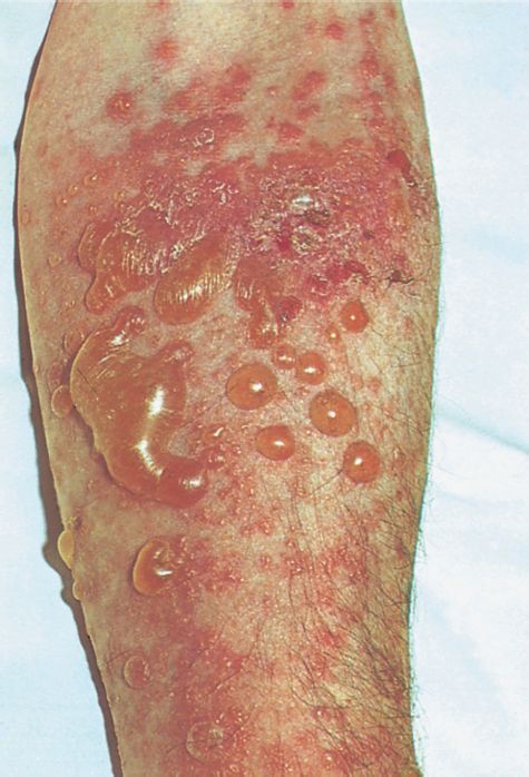 Triệu chứng của bệnh Pemphigoid bọng nước