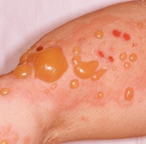 Bệnh Pemphigoid bọng nước