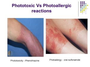 Bệnh da nhạy cảm ánh sáng