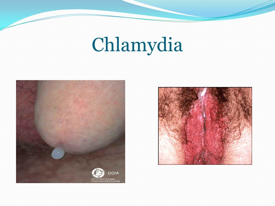 Dấu hiệu nhiễm Chlamydia trachomatis