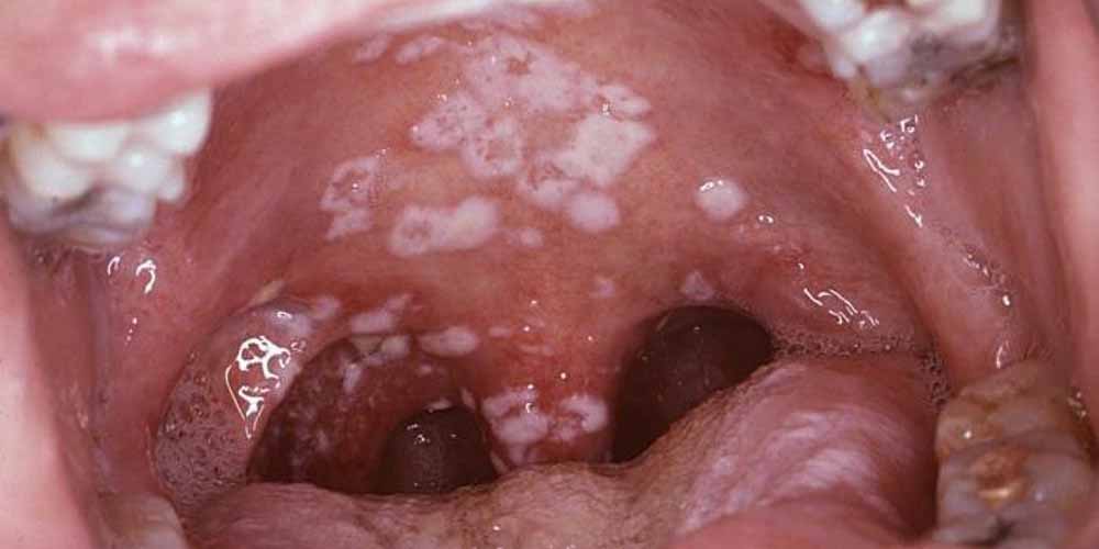 Nhiễm Chlamydia trachomatis ở miệng