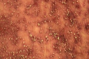 Phát ban mụn mủ lan tỏa cấp tính