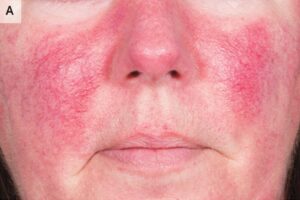 Trứng cá đỏ (rosacea)