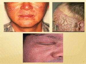 viêm da mạn tính do ánh nắng