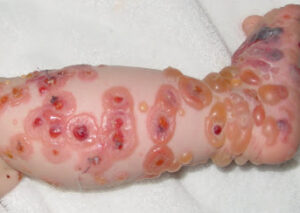 Bệnh IgA bọng nước thành dải