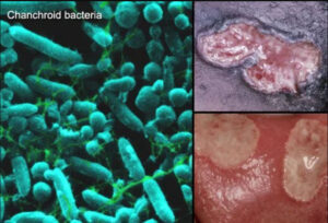 Bệnh hạ cam Chancroid
