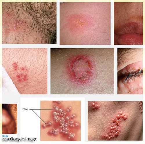 Một số tổn thương của bệnh herpes sinh dục