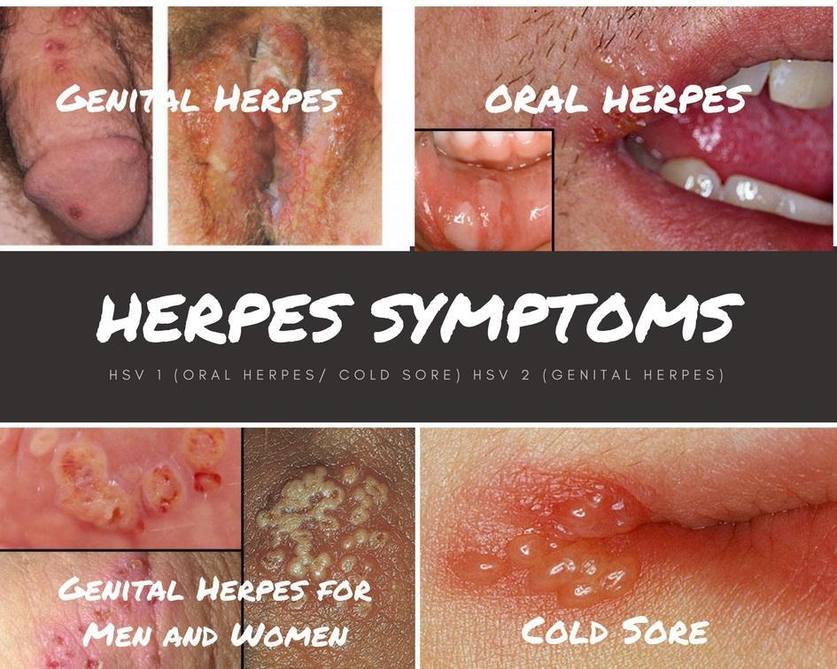 Triệu chứng của bệnh herpes