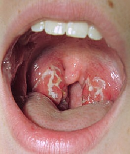 Nhiễm trùng hầu họng ở bệnh lậu