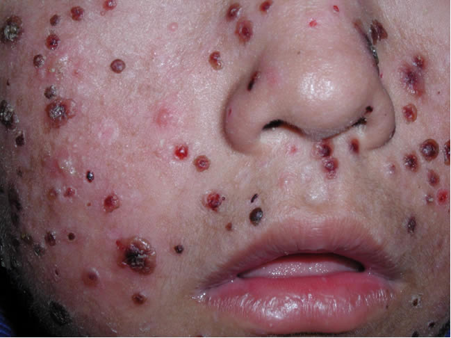 Tổn thương da trong bệnh HV