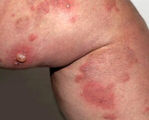 bệnh duhring-brocq