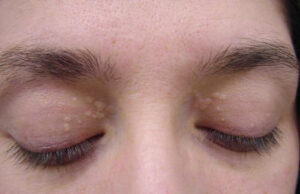 điều trị mụn thịt, u tuyến mồ hôi tại thái bình