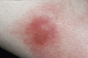 Hồng ban nút (Erythema nodusum)