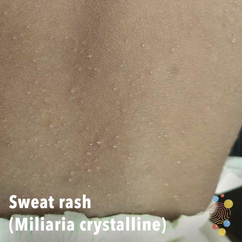 Triệu chứng lâm sàng của rôm sảy thể Miliaria crystalline