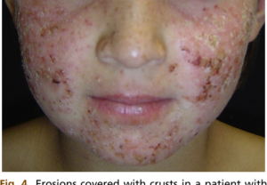 Sẩn ngứa do ánh nắng (AP)