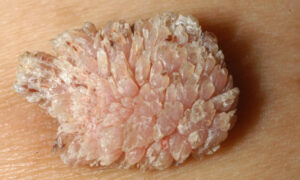 Bệnh sùi mào gà