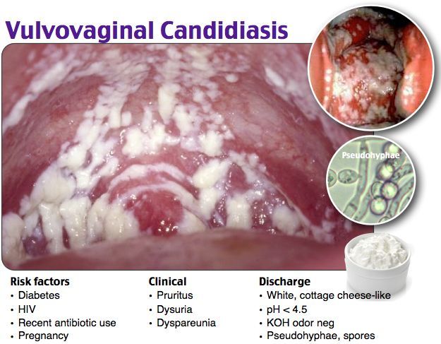 Triệu chứng viêm âm đạo do nấm Candida