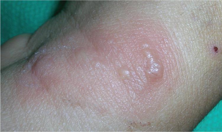 Biểu hiện bệnh herpes trên da