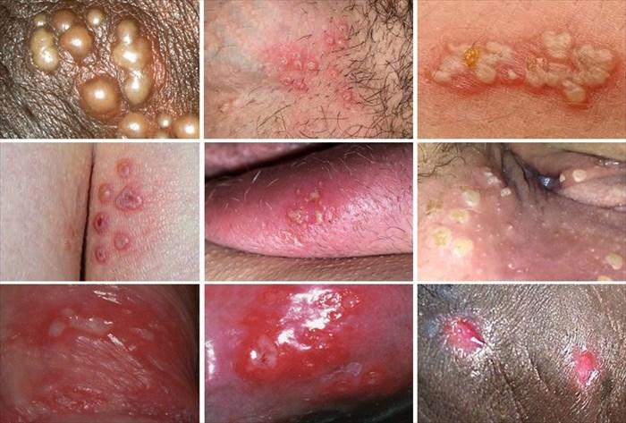 Triệu chứng lâm sàng bệnh herpes