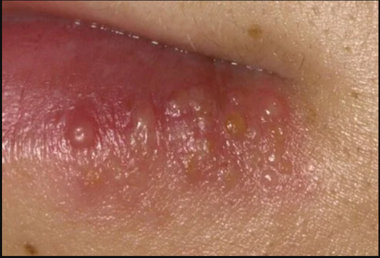 Tổn thương quanh miệng của  bệnh herpes 
