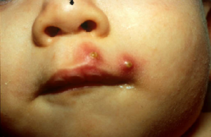 khám bệnh da liễu cho trẻ tại Thái Bình