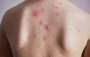 bệnh thủy đậu - triệu chứng và điều trị