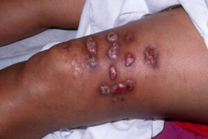 u hạt nhiễm khuẩn