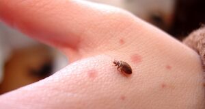 Viêm da do bọ chét