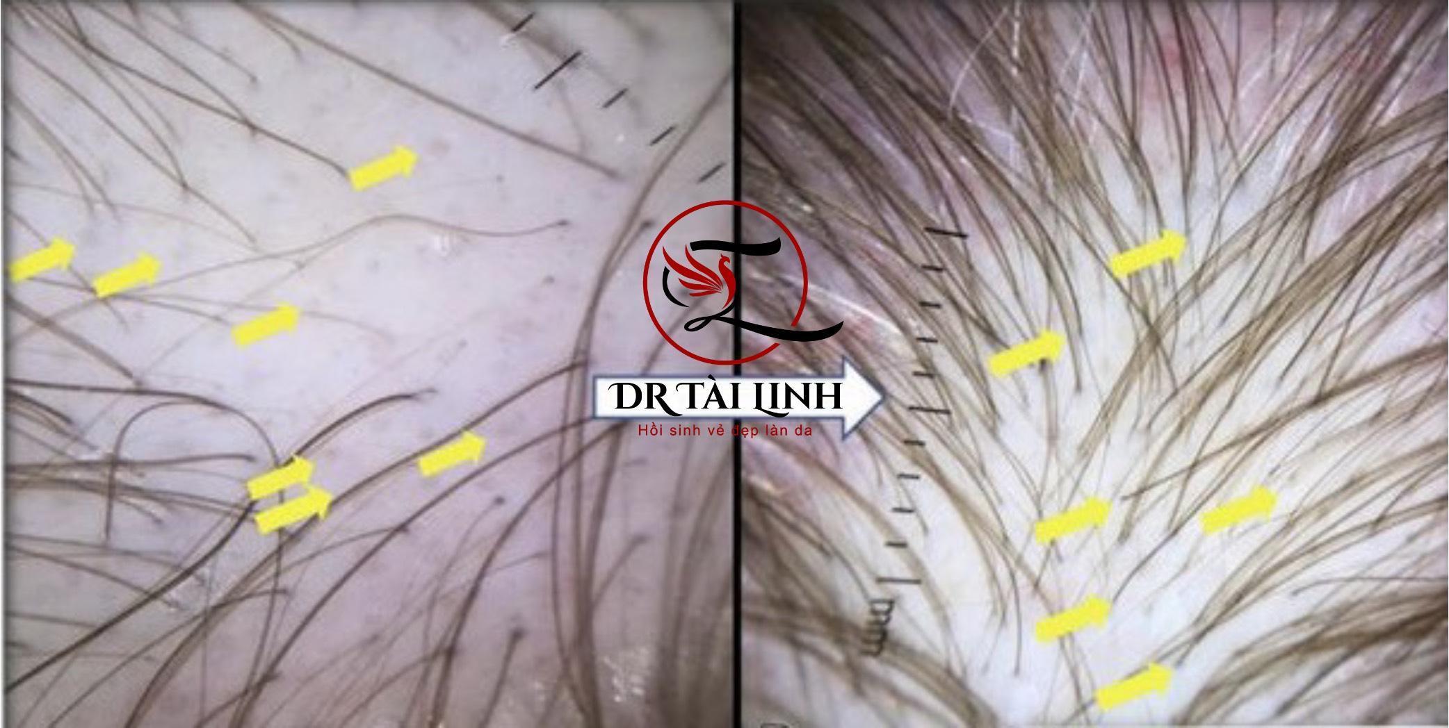 điều trị rụng tóc hiệu quả tại thái bình